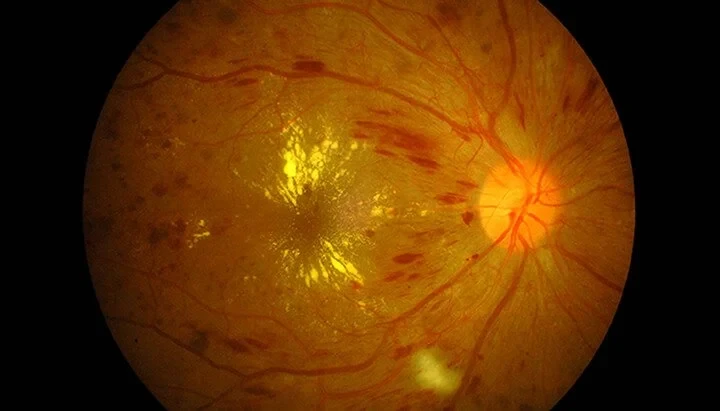 Diabetic eye disease retinal imaging