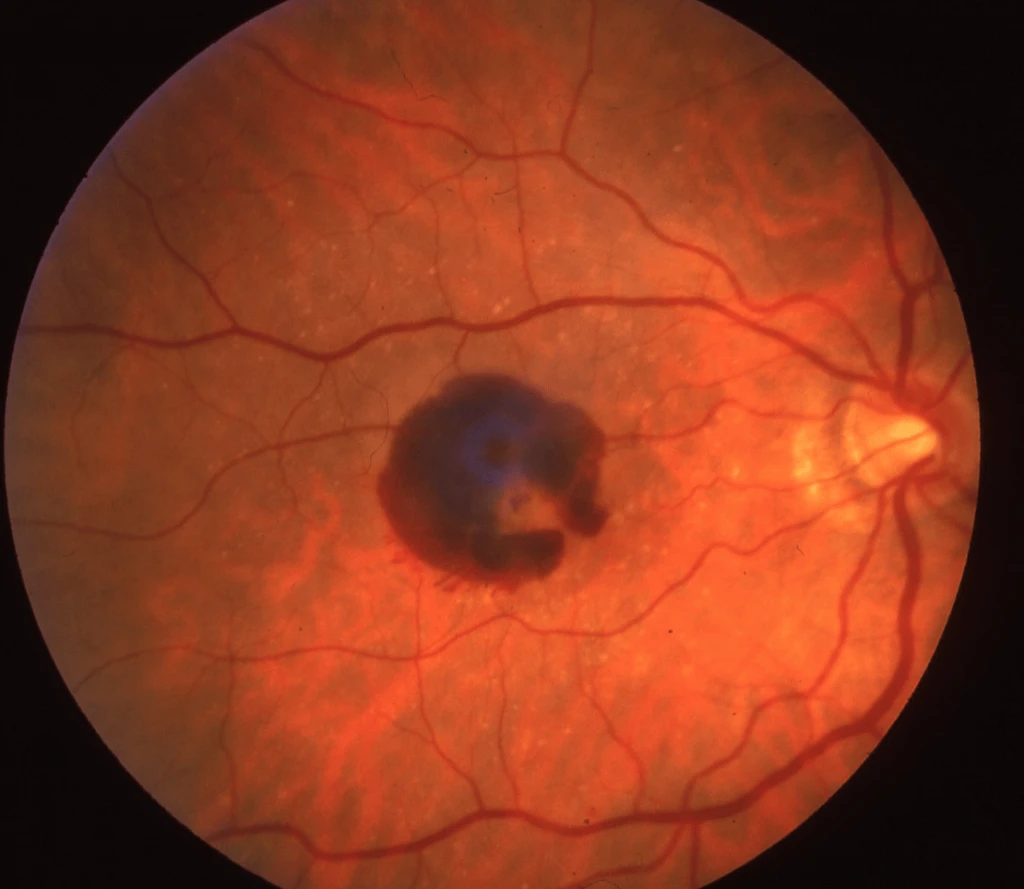 Macular degeneration retinal imaging