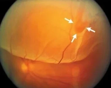 Retinal detachment surgery